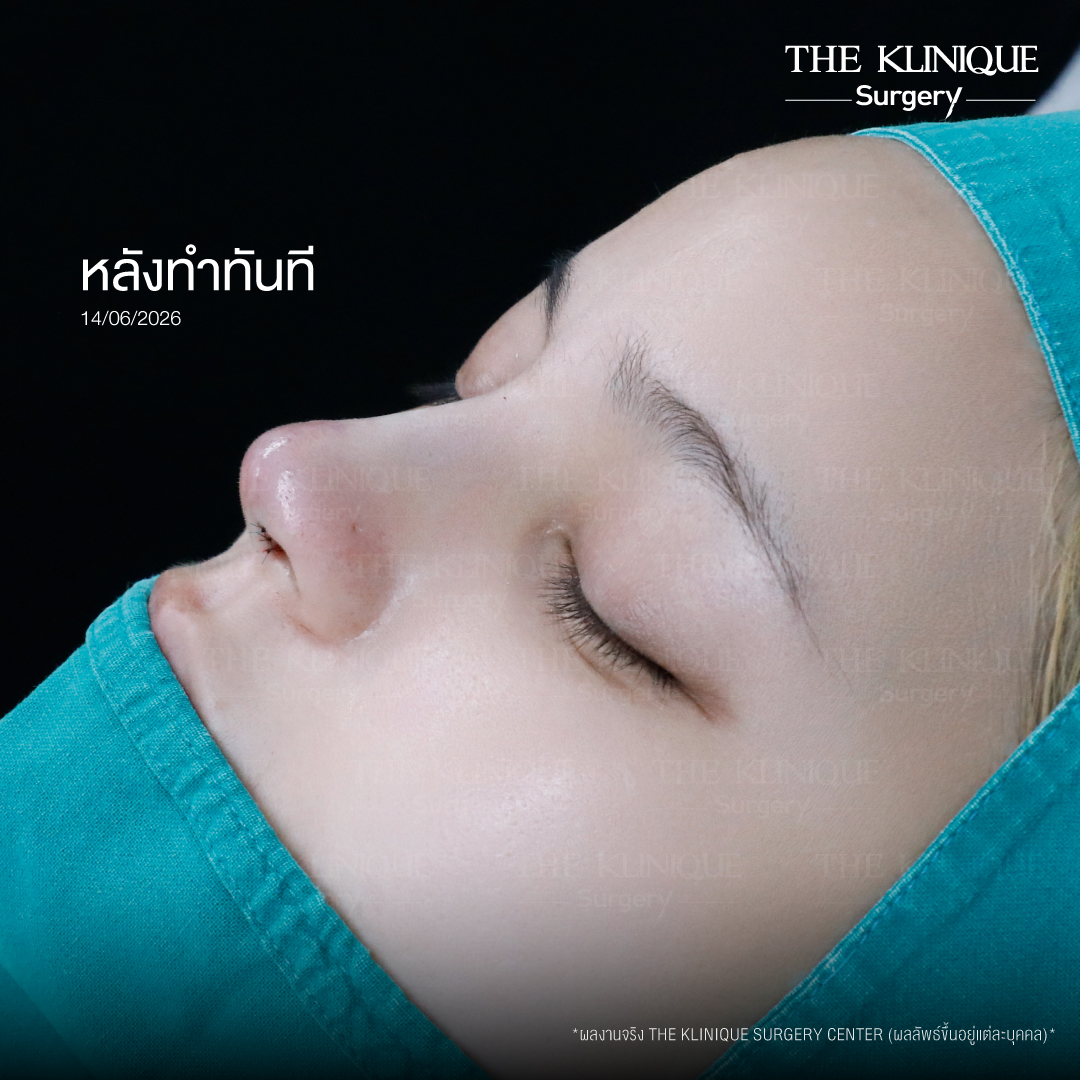 รีวิวเสริมจมูก Semi Open