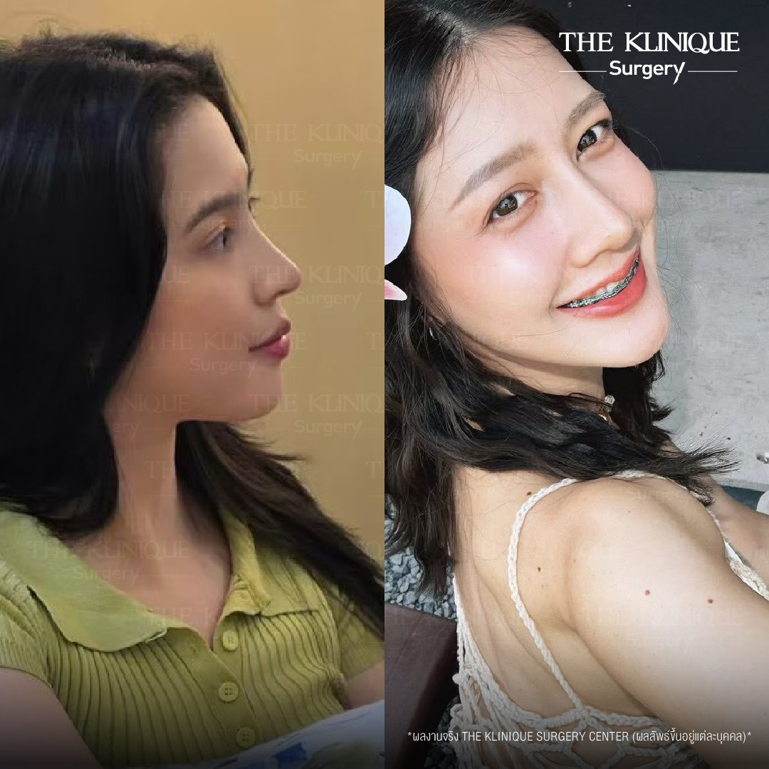 รีวิวเสริมจมูกเทคนิค Semi Open และ Closed