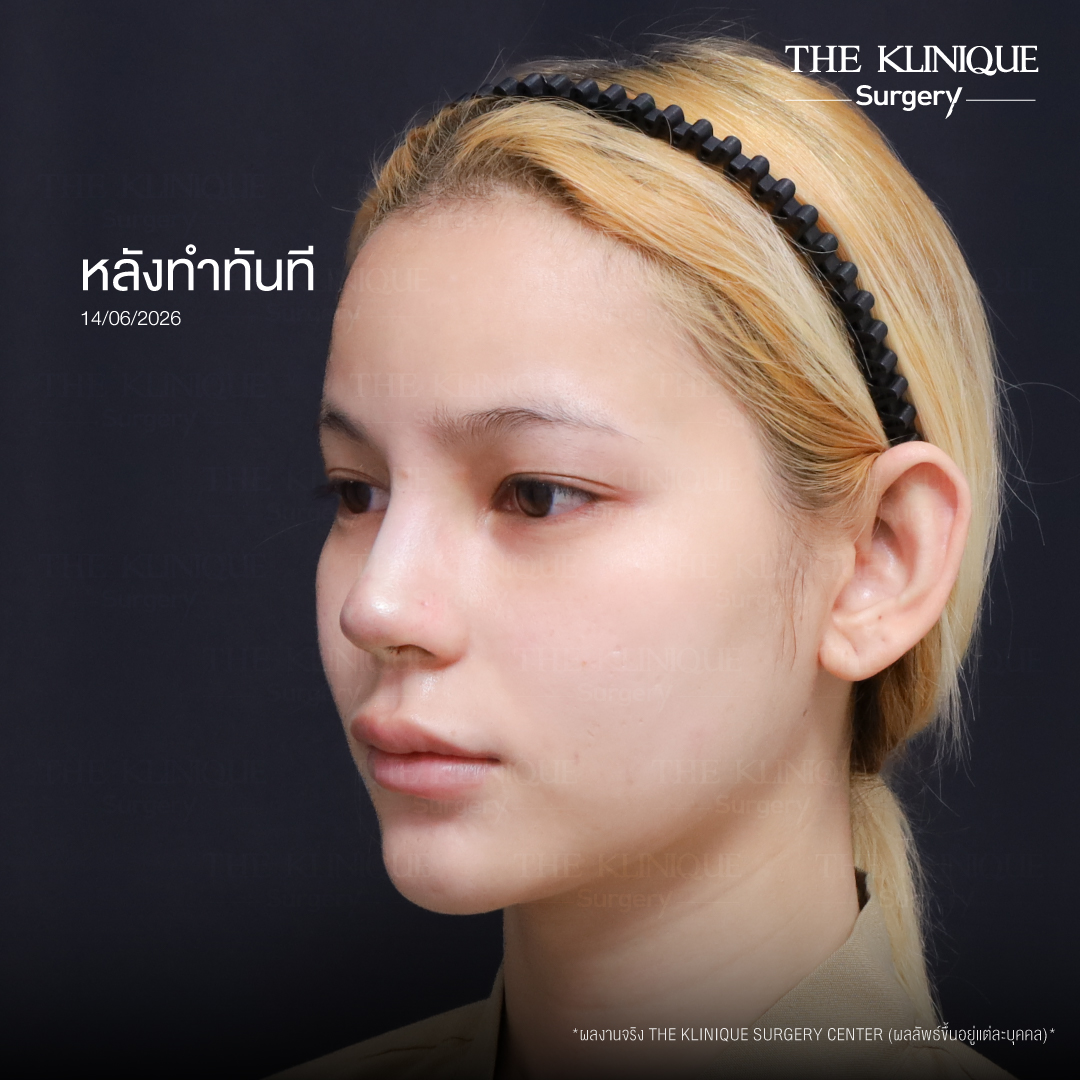 รีวิวเสริมจมูก Semi Open