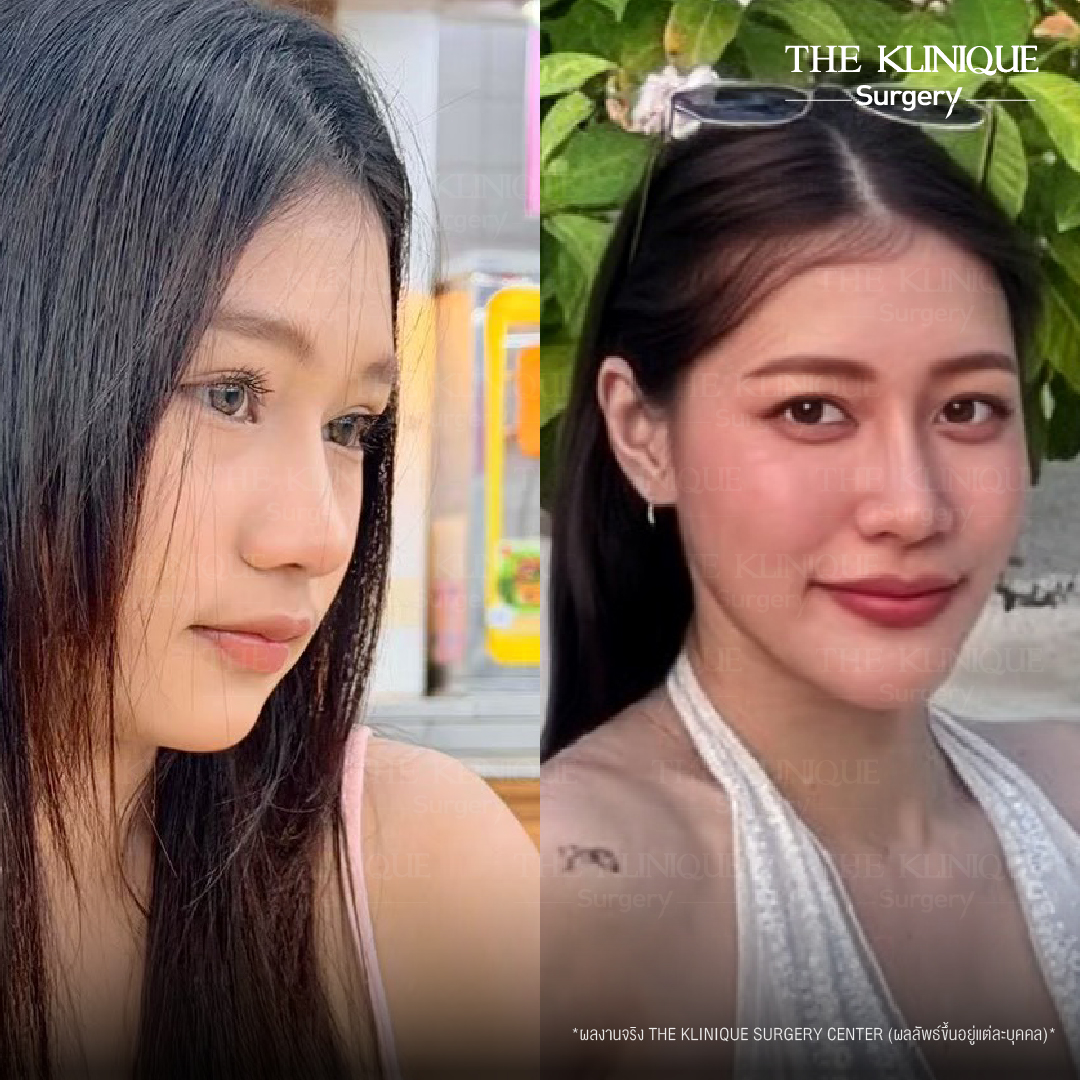 รีวิวเสริมจมูกเทคนิค Semi Open และ Closed