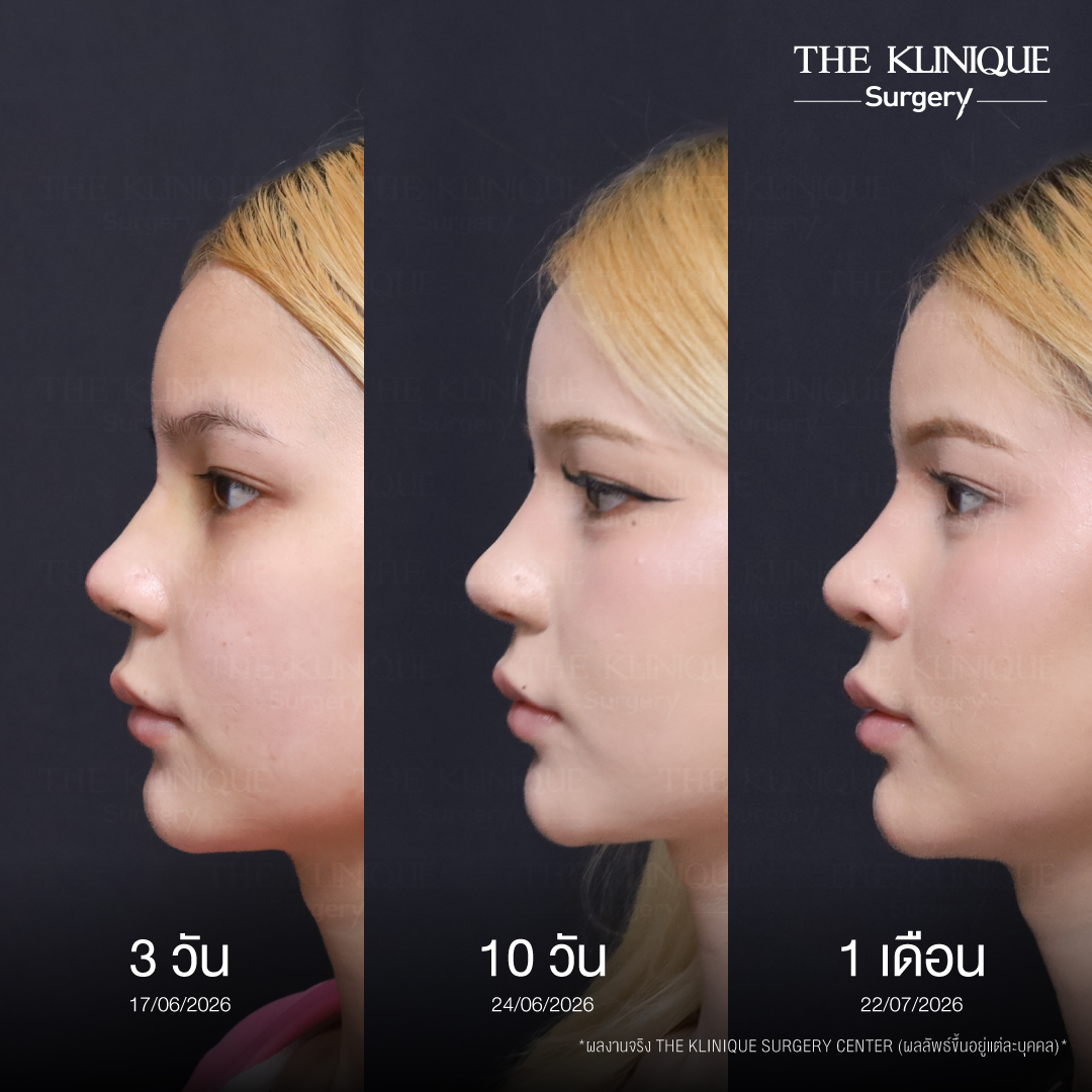 รีวิวเสริมจมูก Semi Open