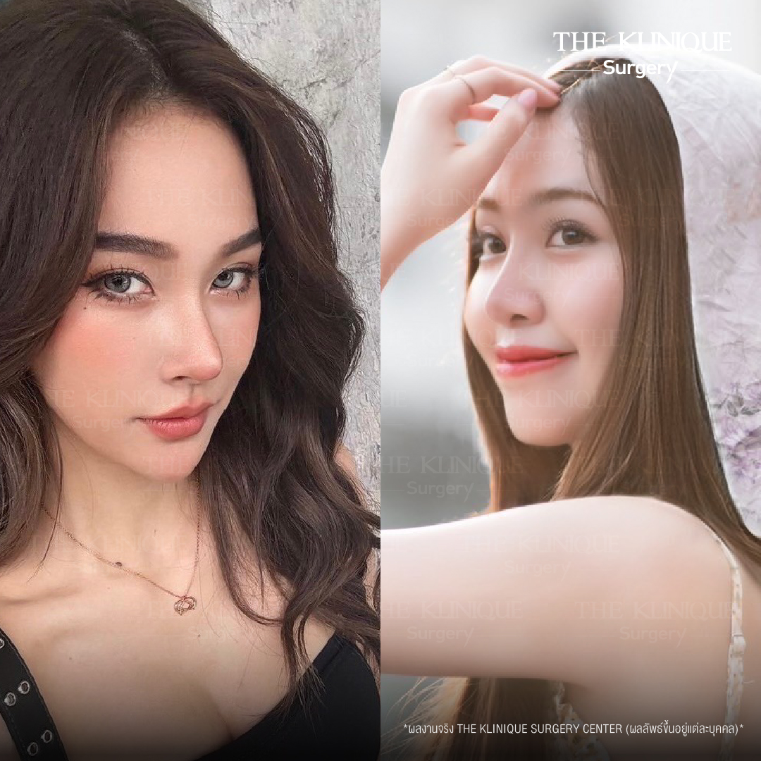 รีวิวเสริมจมูกเทคนิค Semi Open และ Closed