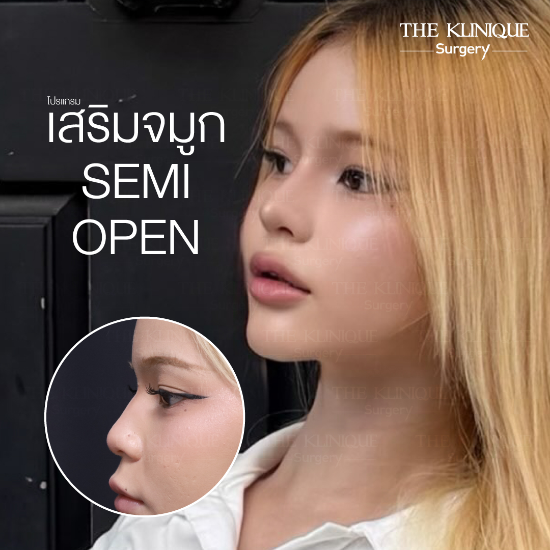 รีวิวเสริมจมูก Semi Open