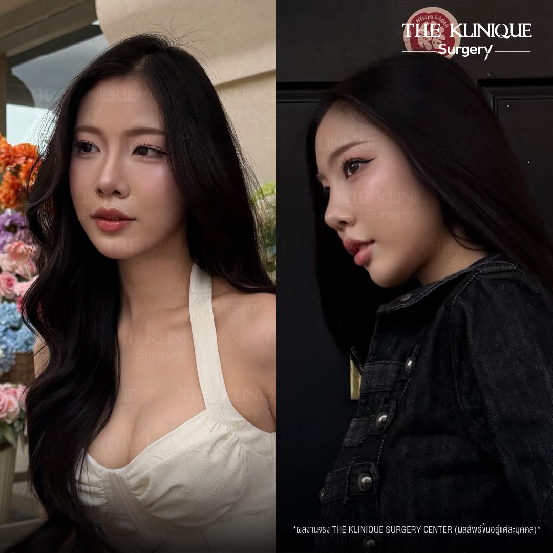 รีวิวเสริมจมูกเทคนิค Semi Open และ Closed