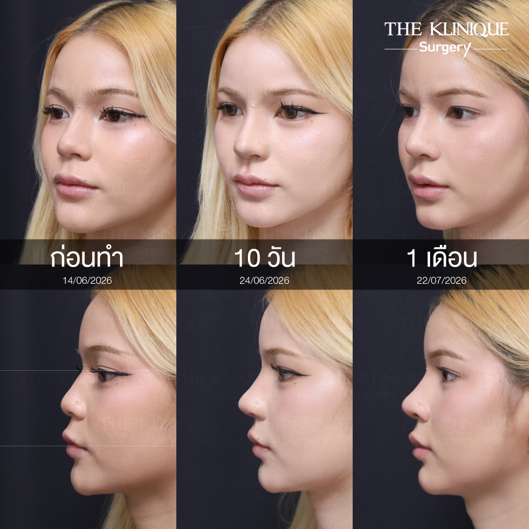 รีวิวเสริมจมูก Semi Open