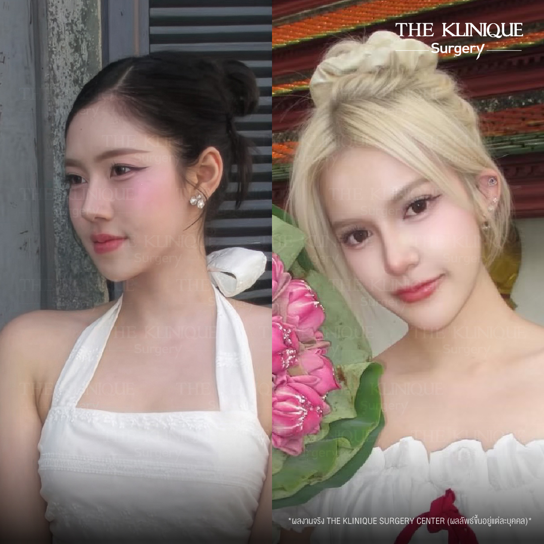 รีวิวเสริมจมูกเทคนิค Semi Open และ Closed