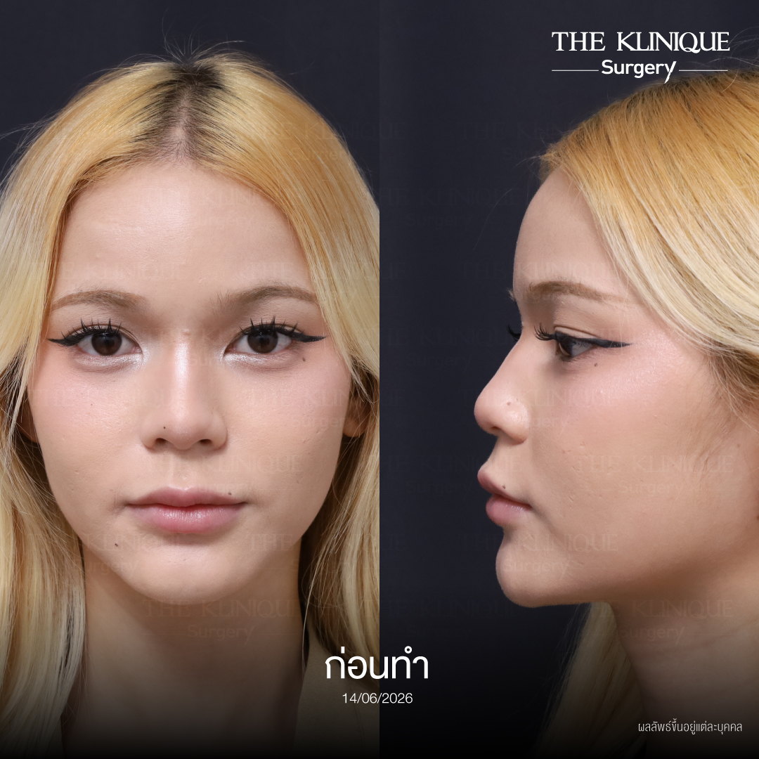 รีวิวเสริมจมูก Semi Open