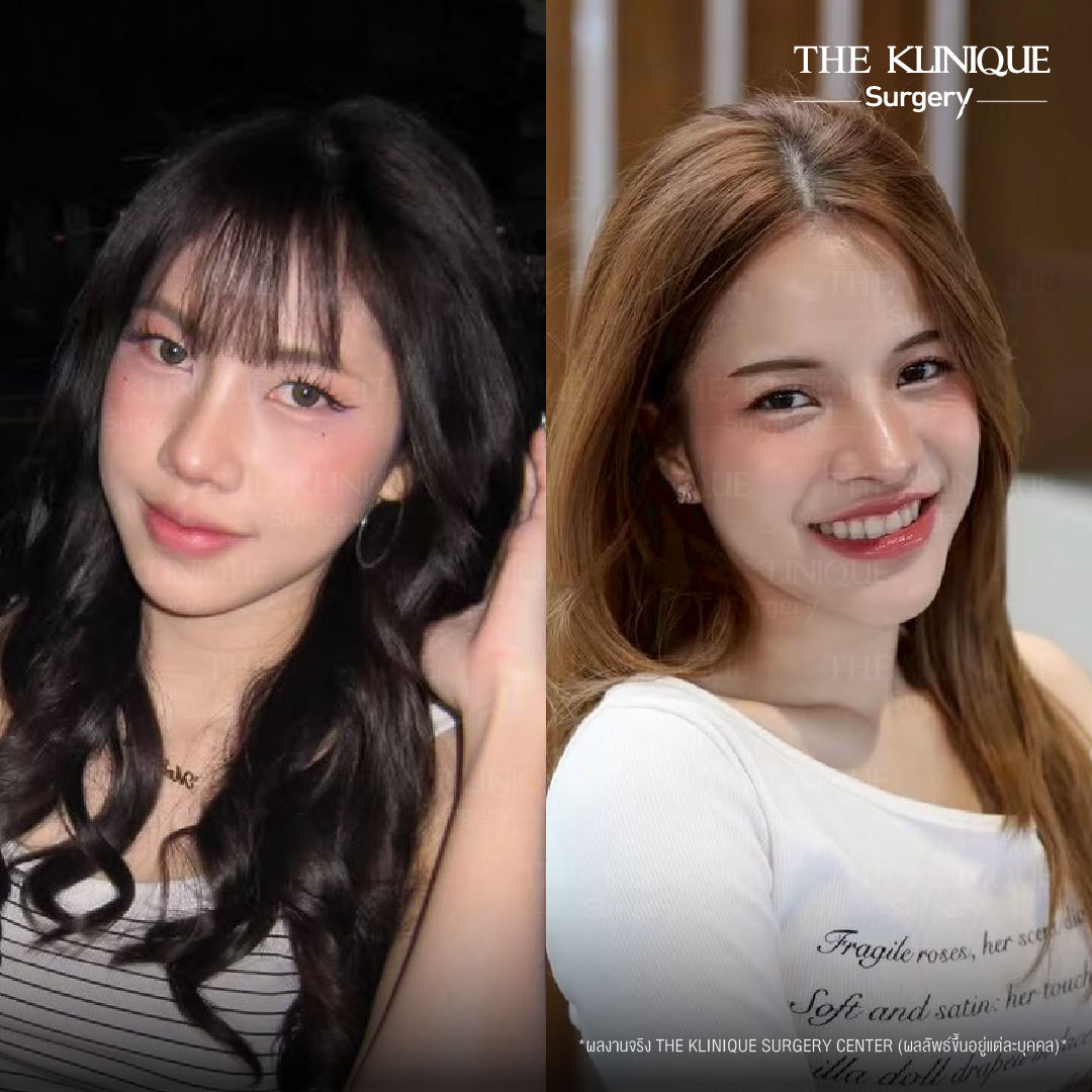 รีวิวเสริมจมูกเทคนิค Semi Open และ Closed