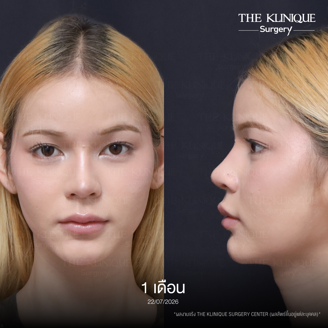 รีวิวเสริมจมูก Semi Open