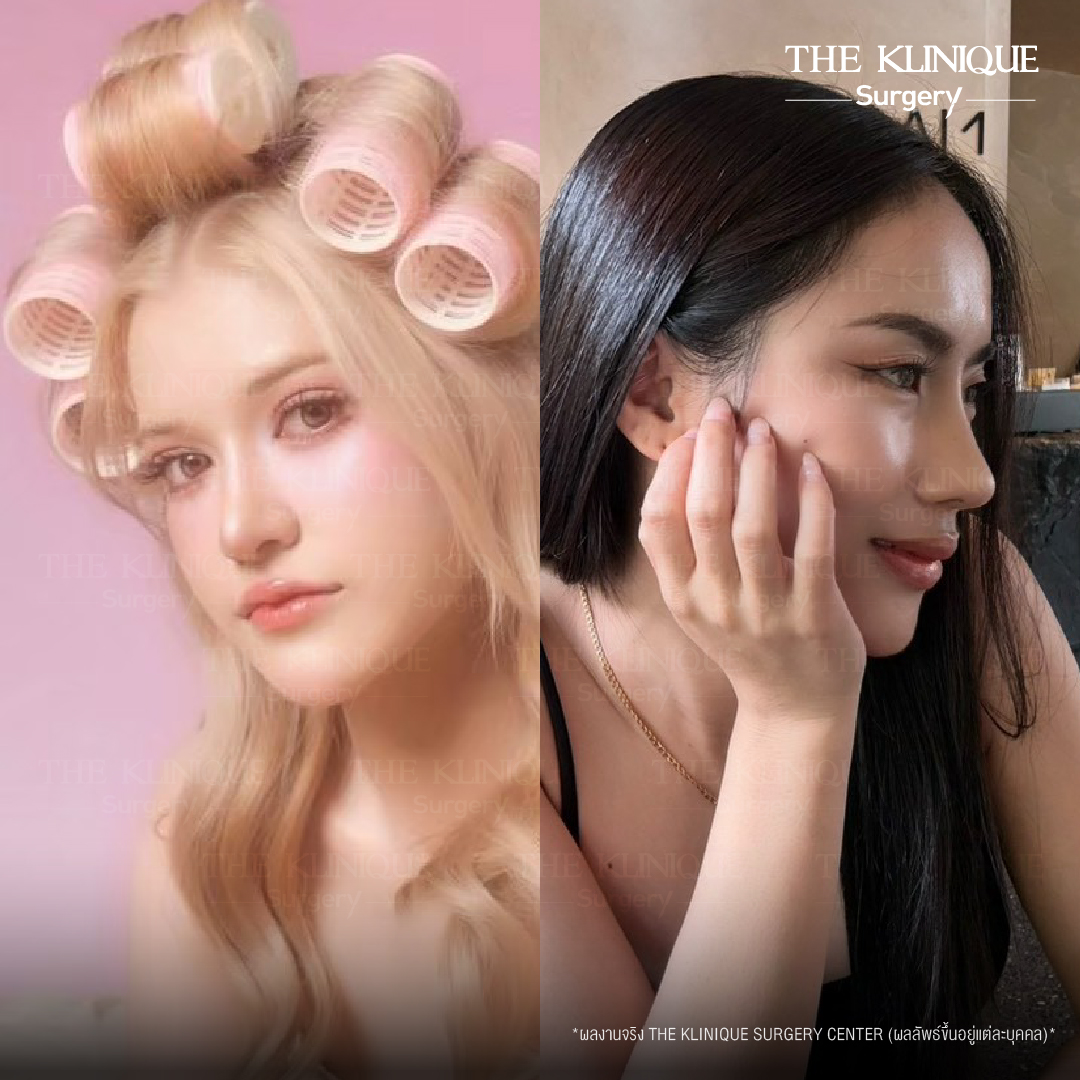 รีวิวเสริมจมูกเทคนิค Semi Open และ Closed