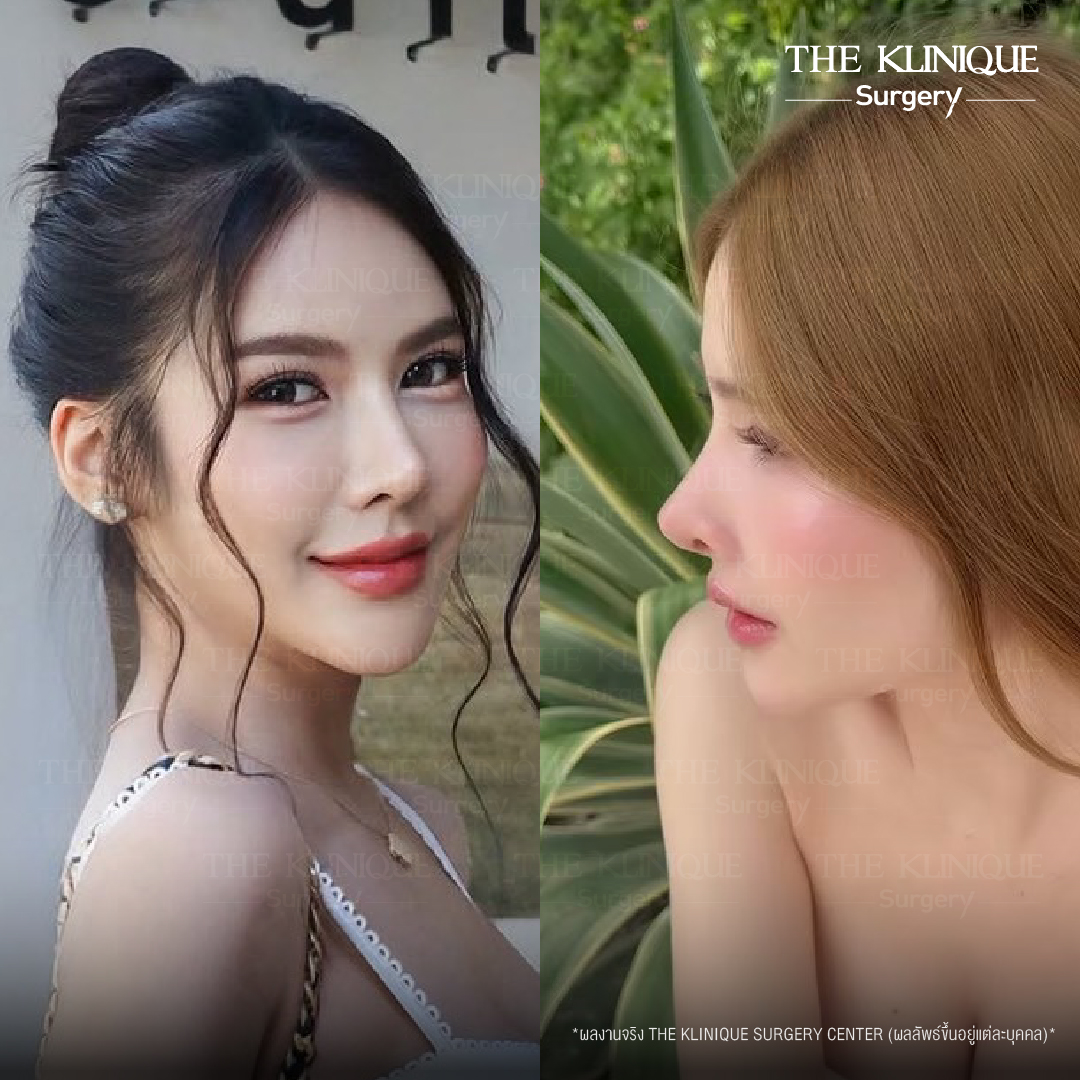 รีวิวเสริมจมูกเทคนิค Semi Open และ Closed