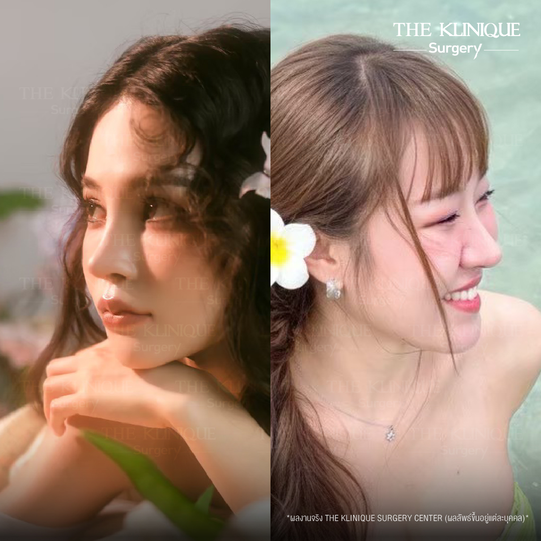 รีวิวเสริมจมูกเทคนิค Semi Open และ Closed
