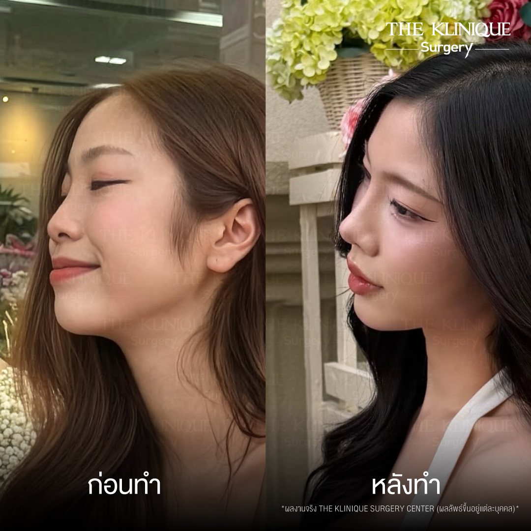 รีวิวเสริมจมูก Semi Open