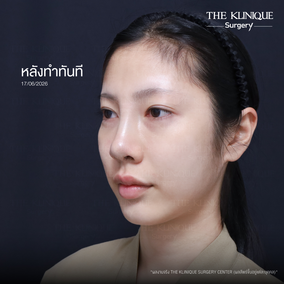 รีวิวเสริมจมูก Semi Open