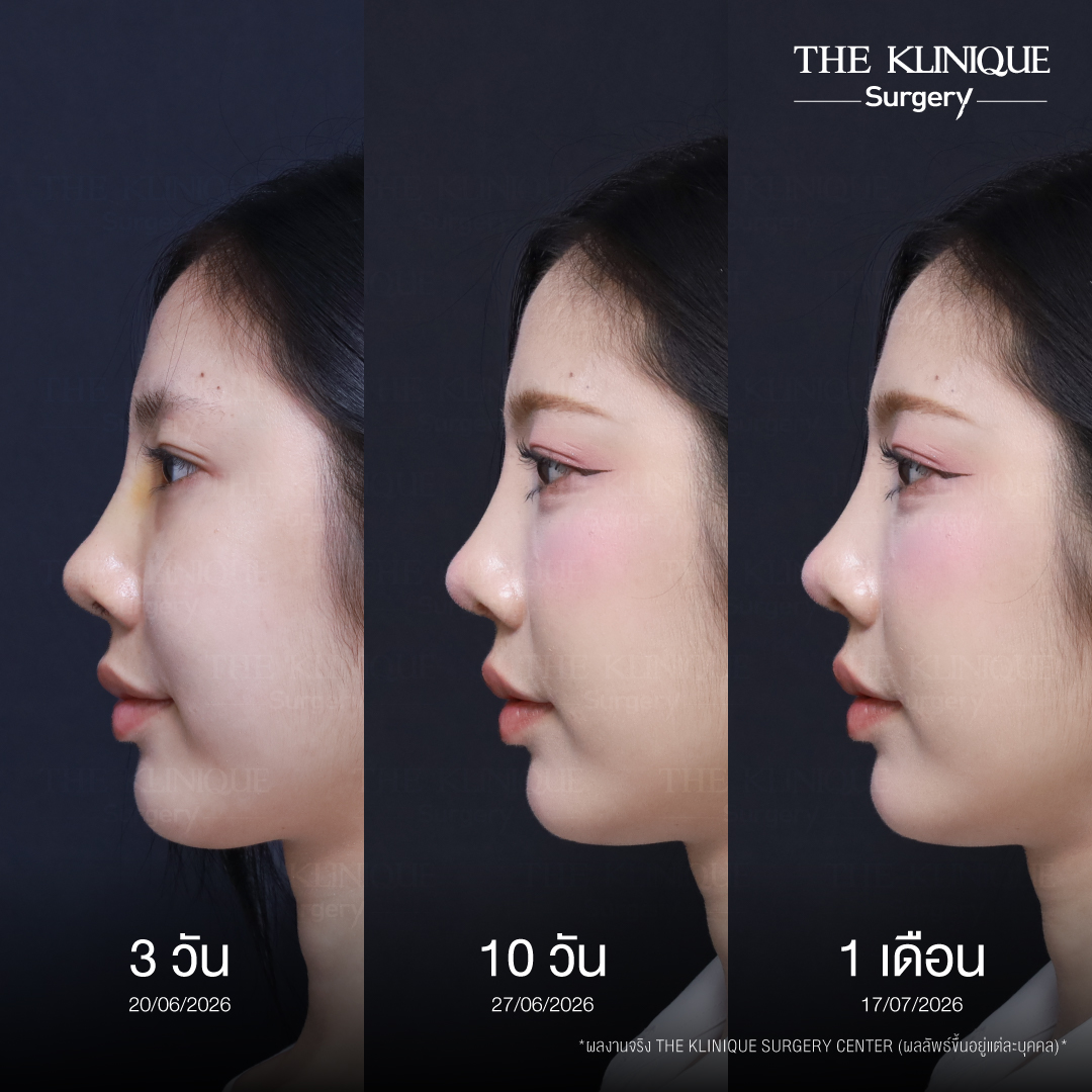 รีวิวเสริมจมูก Semi Open