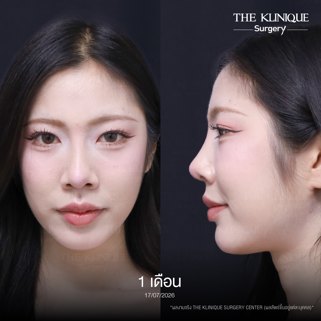 รีวิวเสริมจมูก Semi Open