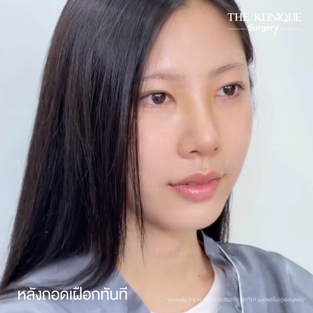 รีวิวเสริมจมูก Semi Open