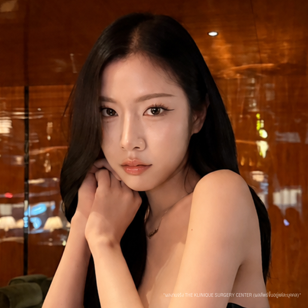 รีวิวเสริมจมูก Semi Open