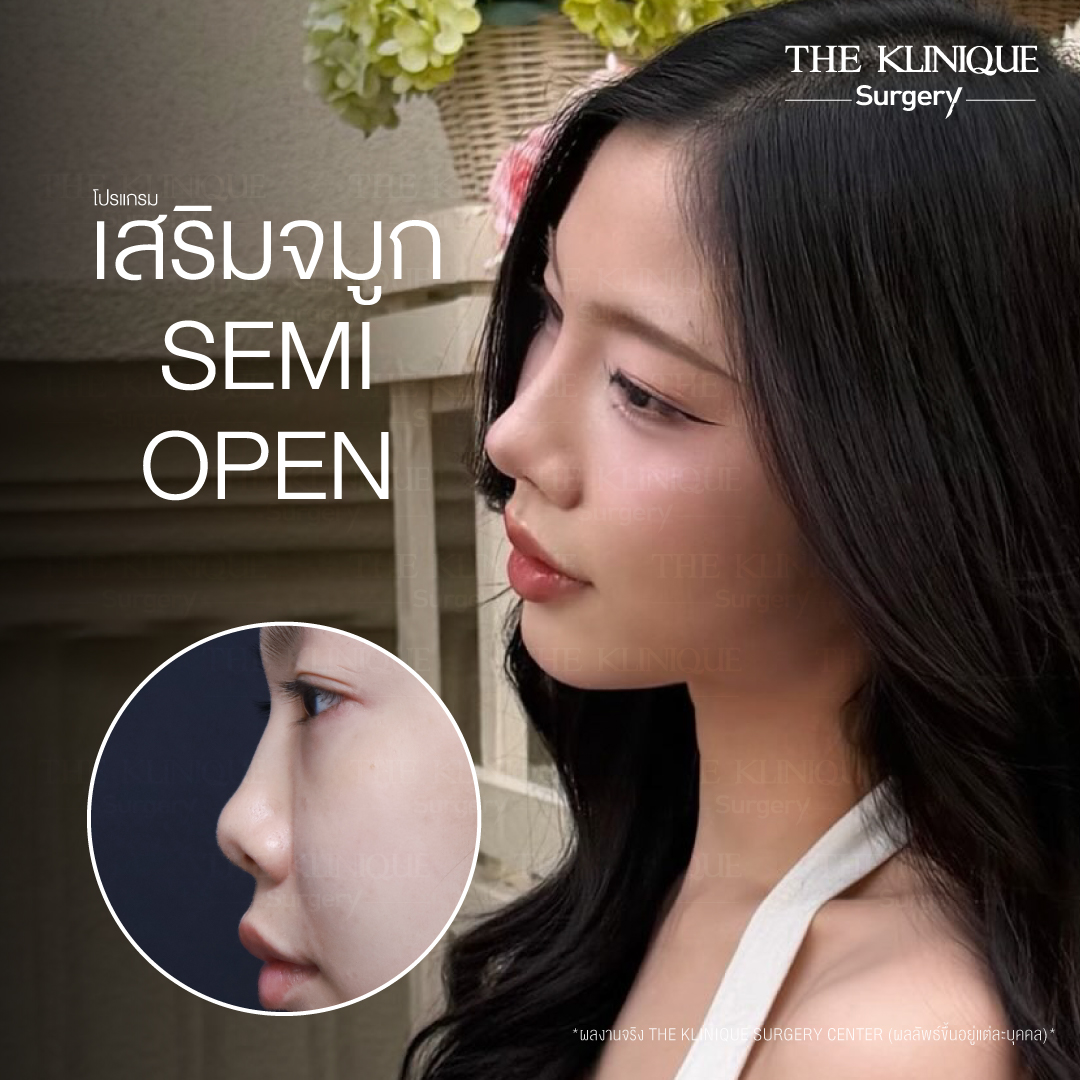 รีวิวเสริมจมูก Semi Open