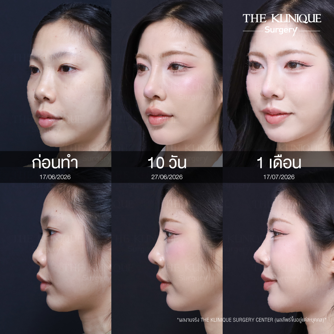 รีวิวเสริมจมูก Semi Open