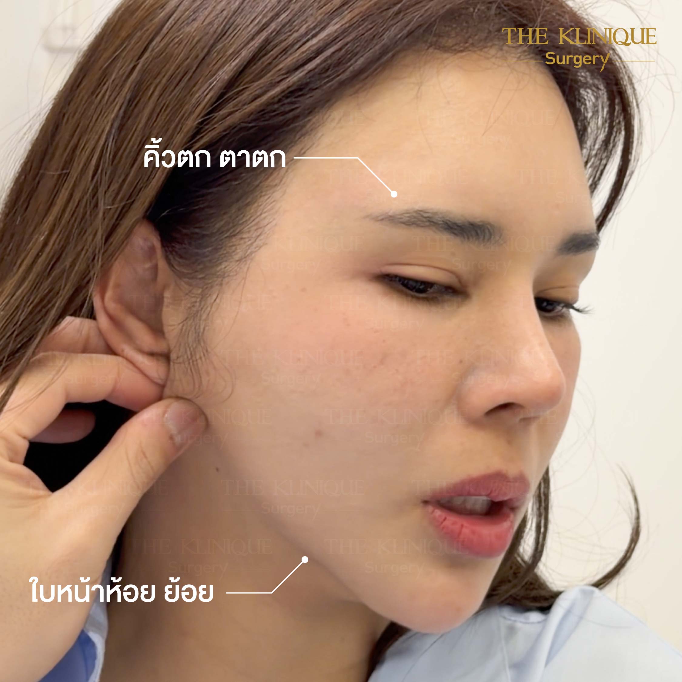 รีวิวดึงหน้า Facelift