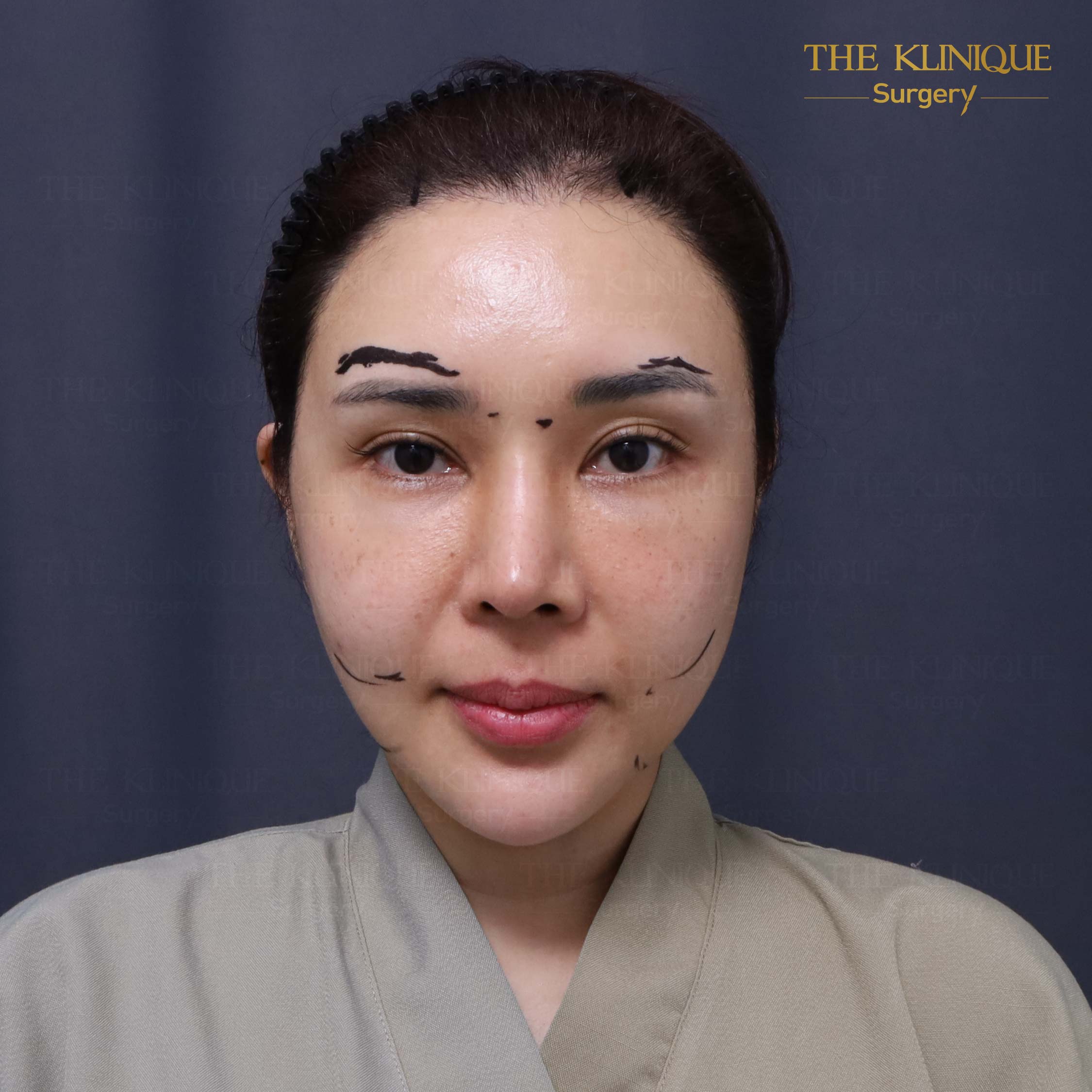 รีวิวดึงหน้า Facelift & ยกคิ้ว Edotine