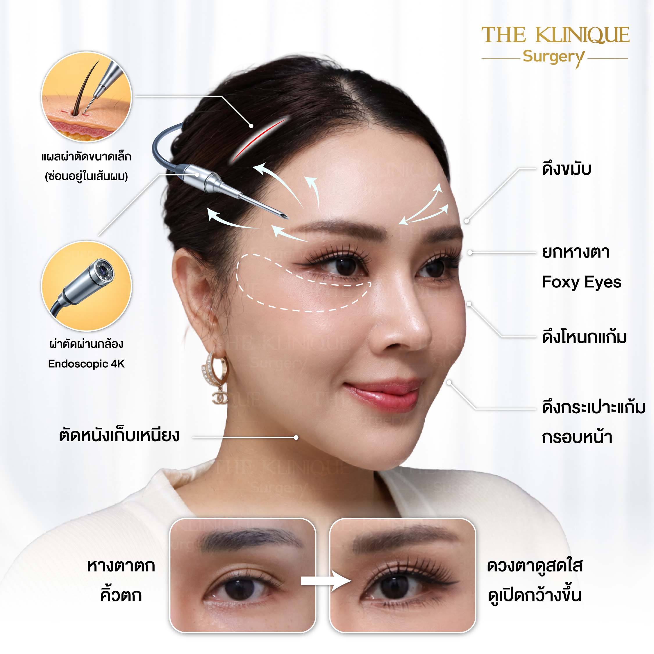 รีวิวดึงหน้า Facelift & ยกคิ้ว Edotine