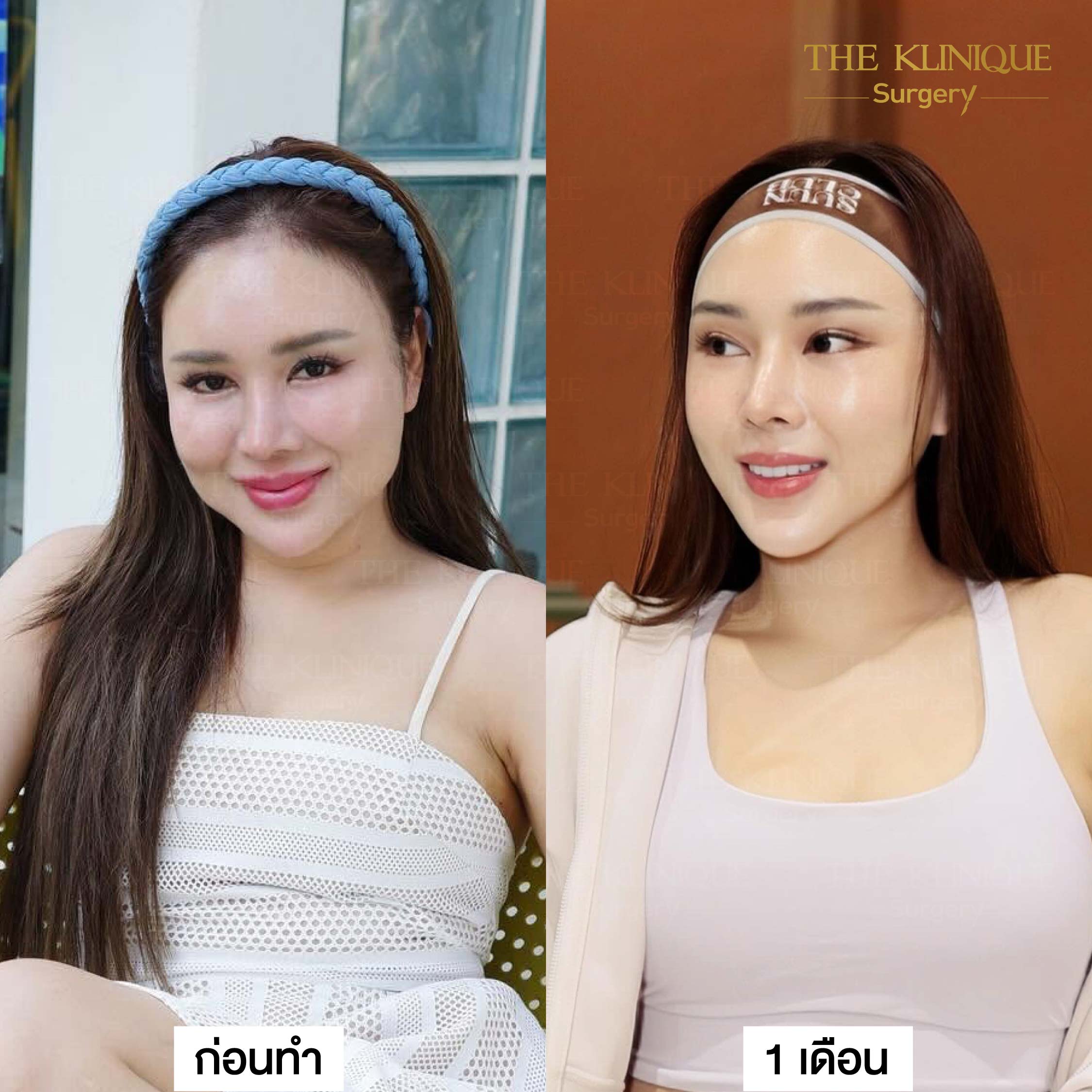 รีวิวดึงหน้า Facelift & ยกคิ้ว Edotine