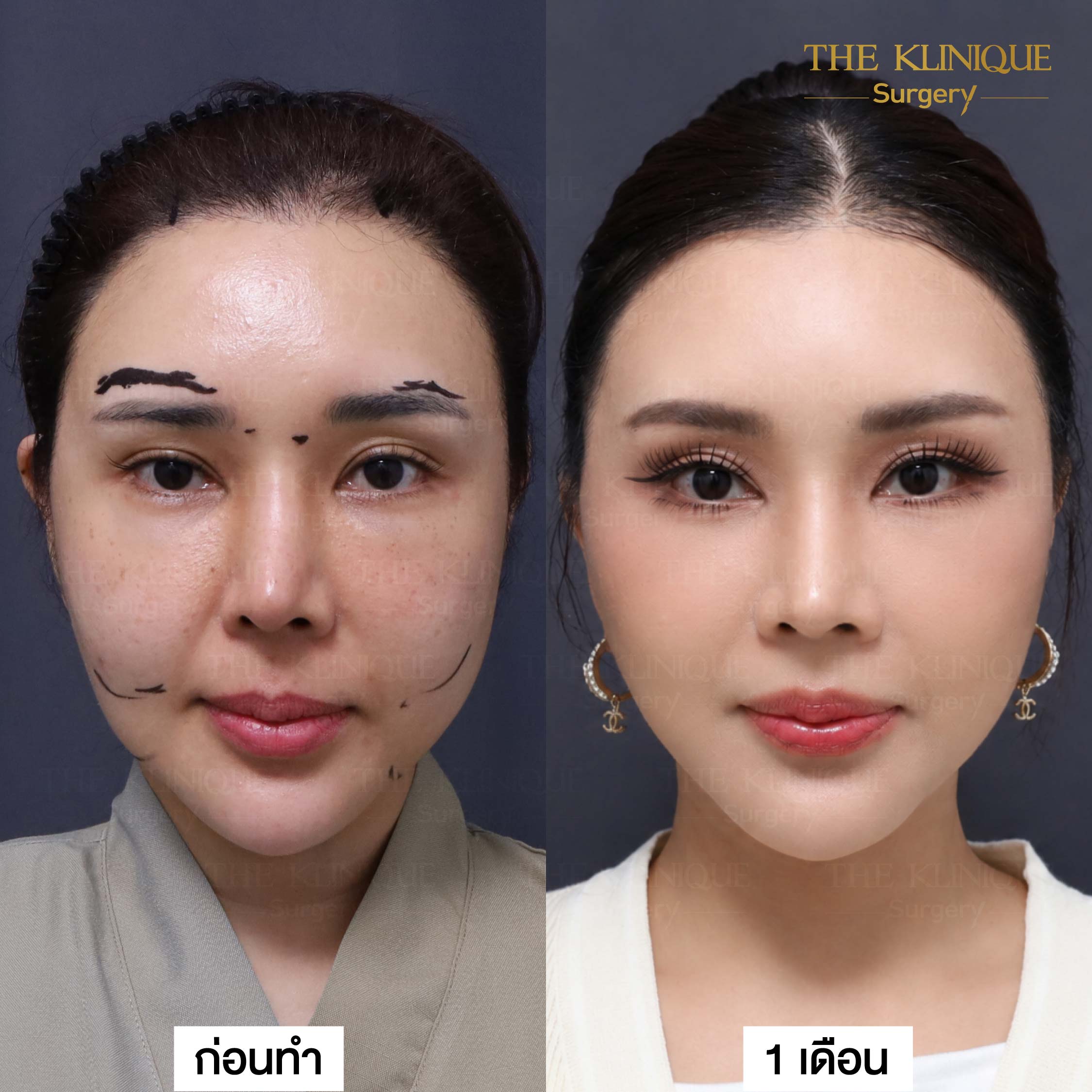 รีวิวดึงหน้า Facelift & ยกคิ้ว Edotine