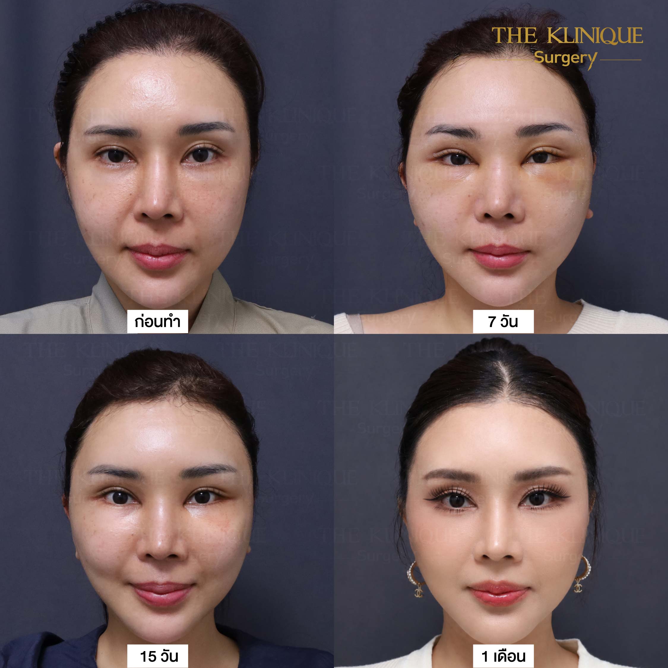 รีวิวดึงหน้า Facelift & ยกคิ้ว Edotine