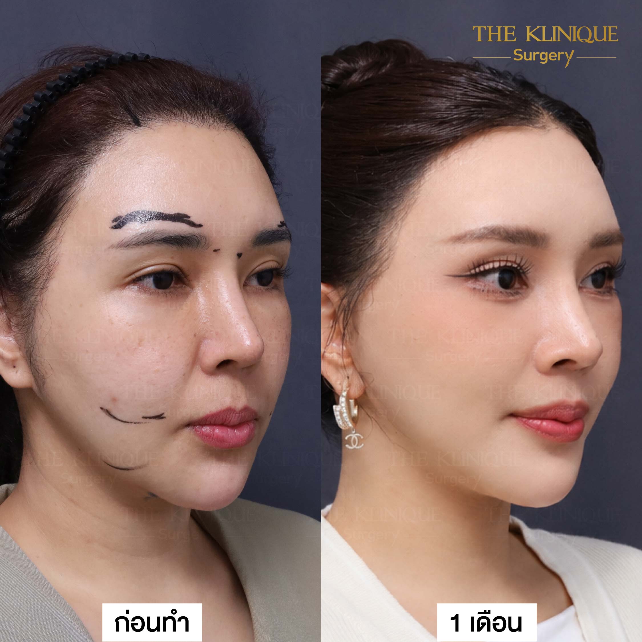 รีวิวดึงหน้า Facelift & ยกคิ้ว Edotine