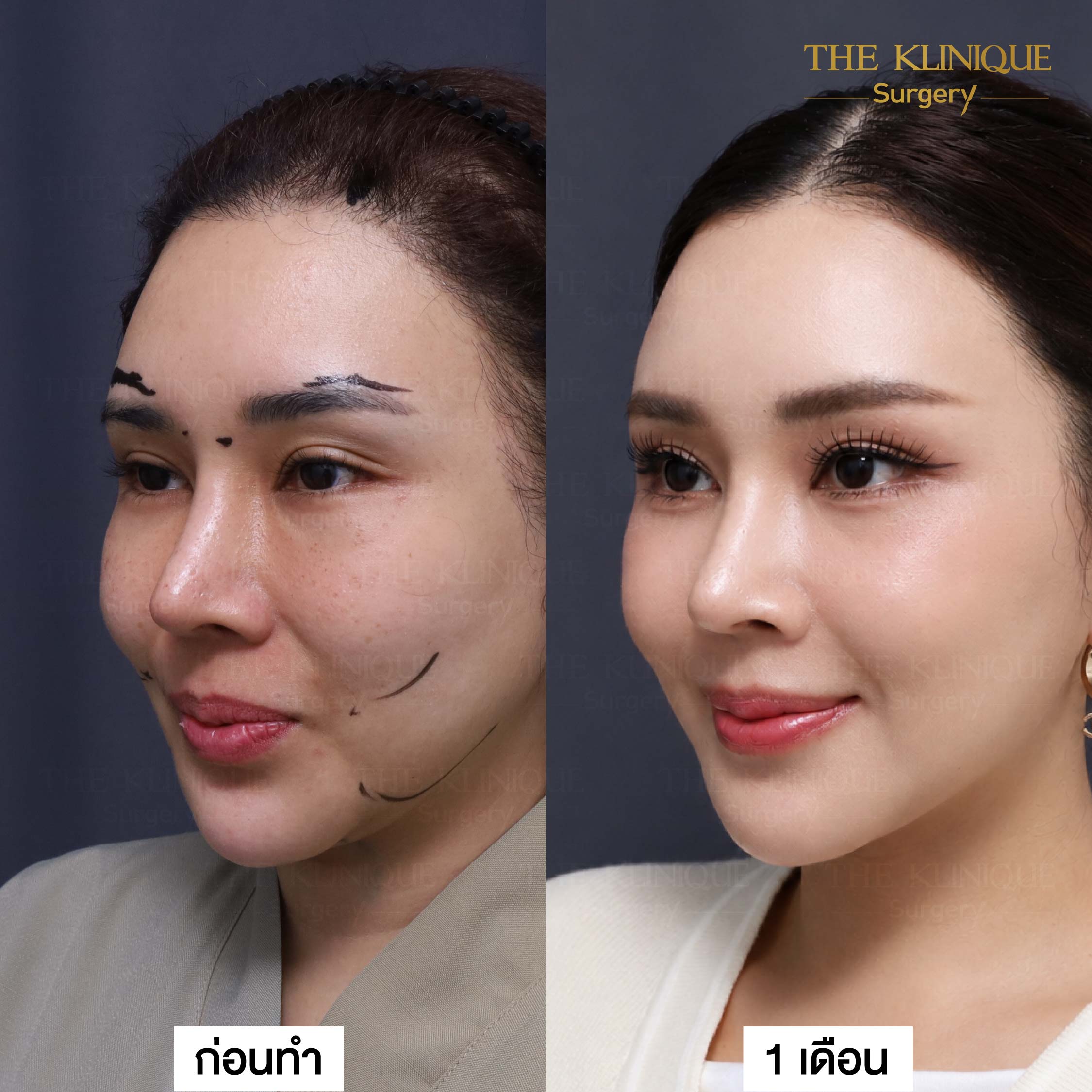รีวิวดึงหน้า Facelift & ยกคิ้ว Edotine