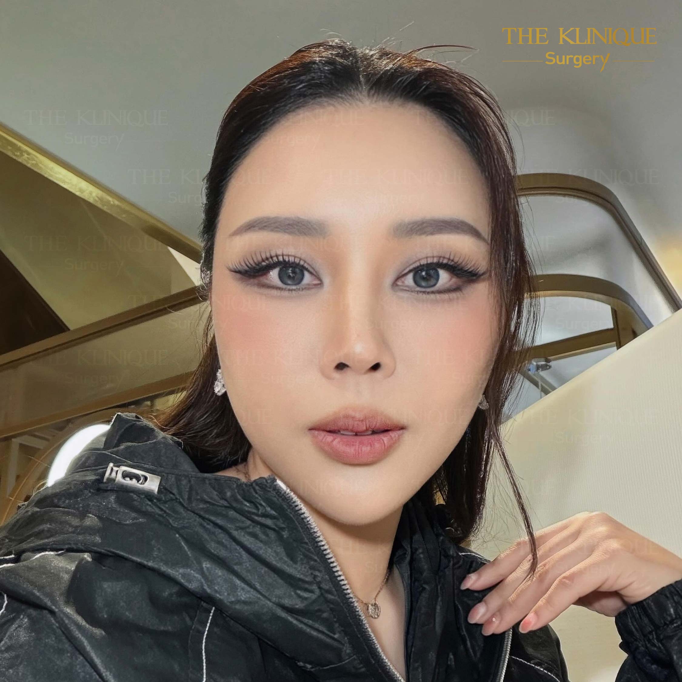 รีวิวดึงหน้า Facelift & ยกคิ้ว Edotine