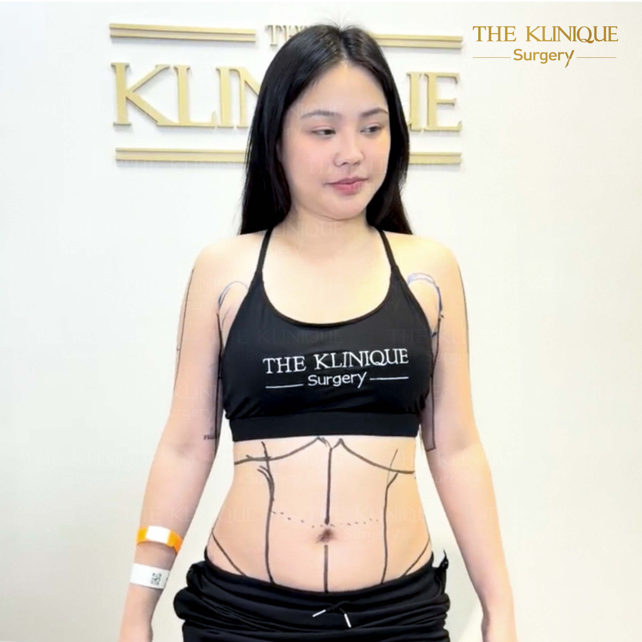 รีวิว ดูดไขมัน (Liposuction) แขน หน้าท้อง
