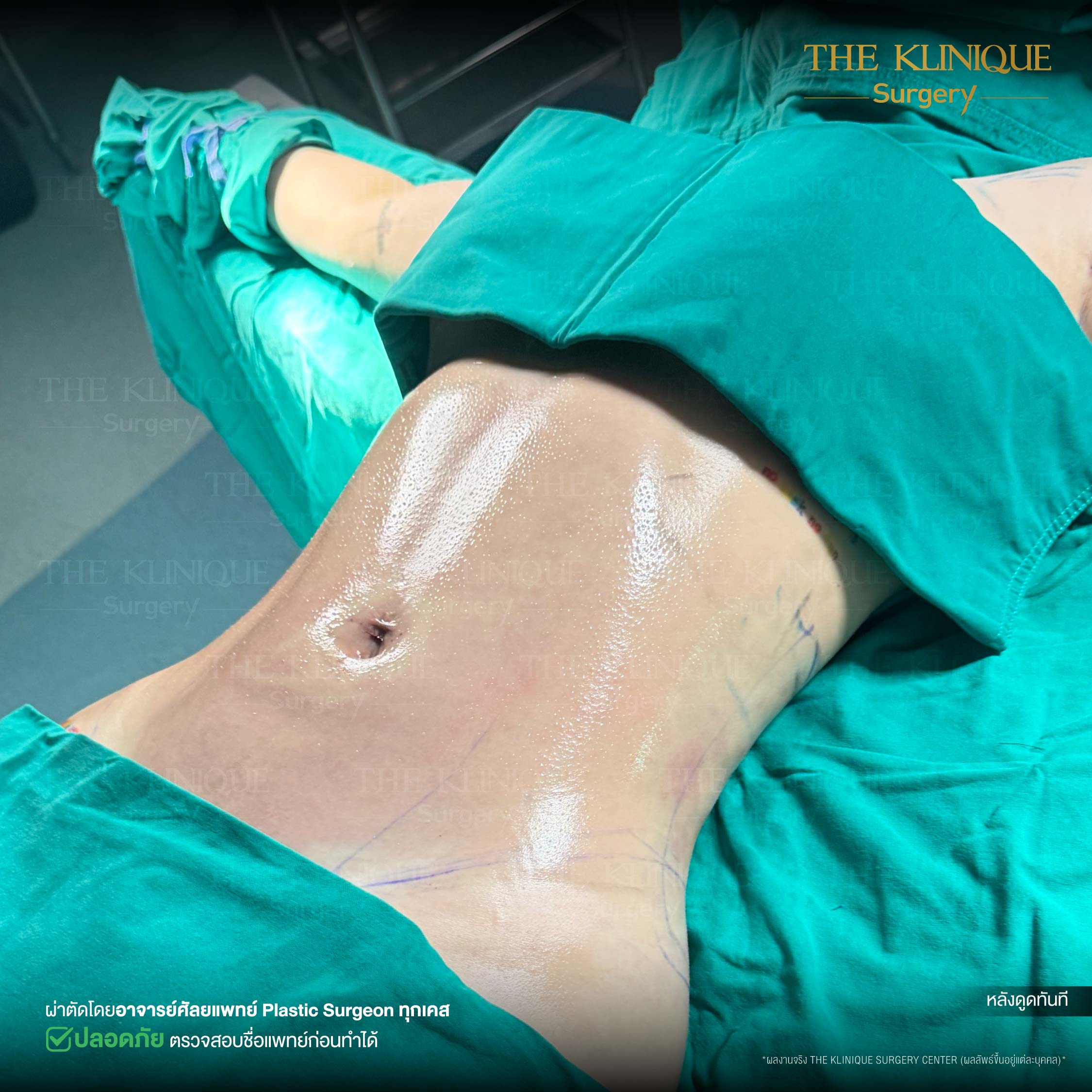 รีวิว ดูดไขมัน (Liposuction) หน้าท้อง