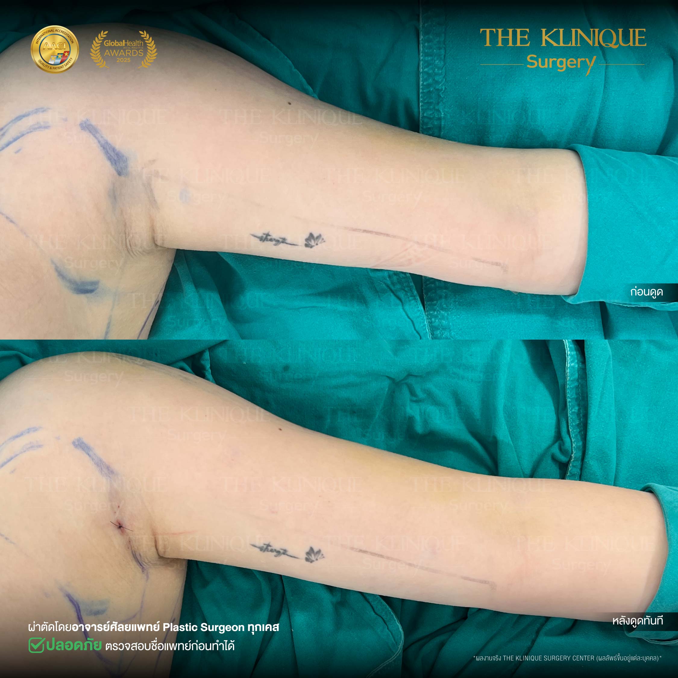 รีวิว ดูดไขมัน (Liposuction) แขน