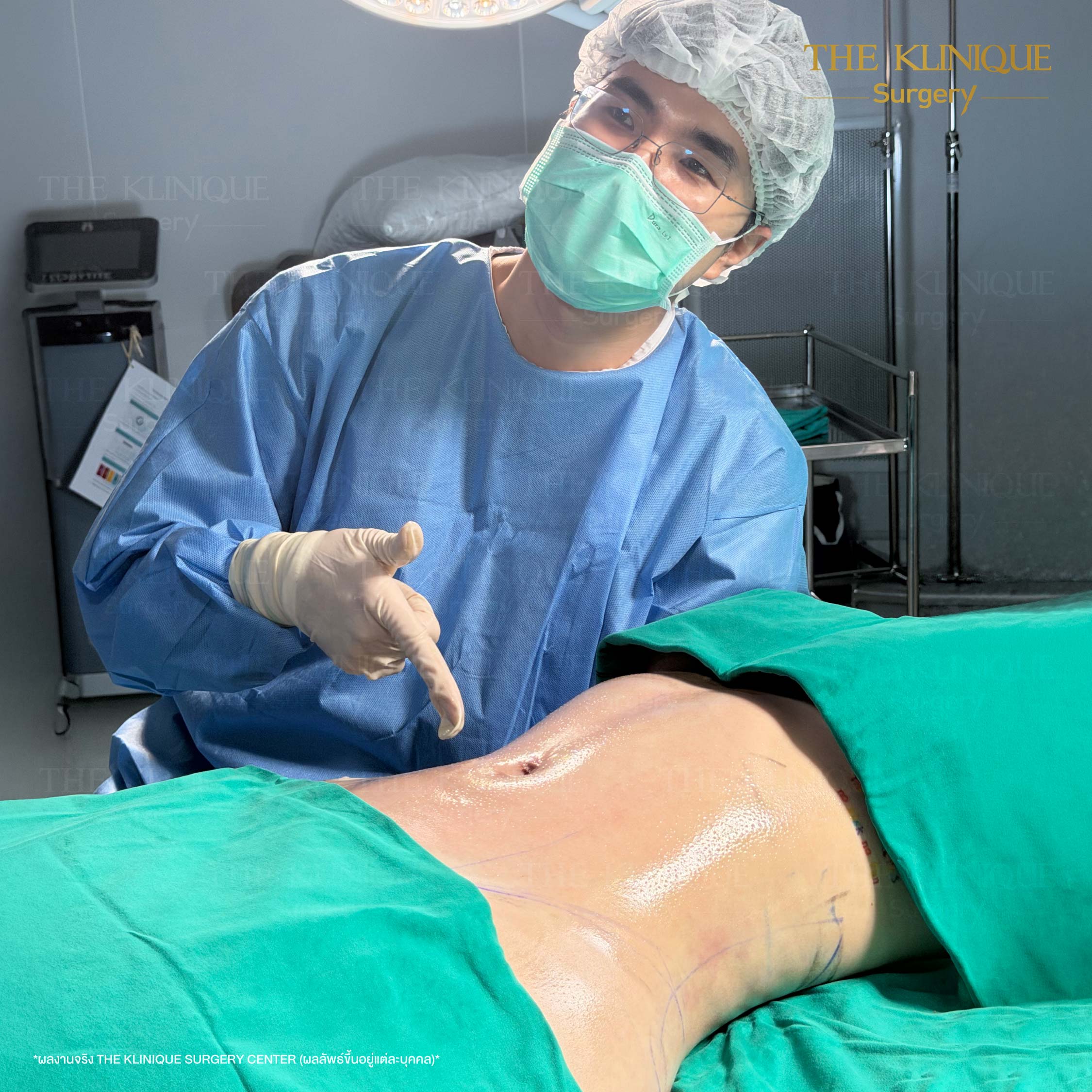 รีวิว ดูดไขมัน (Liposuction) หน้าท้อง