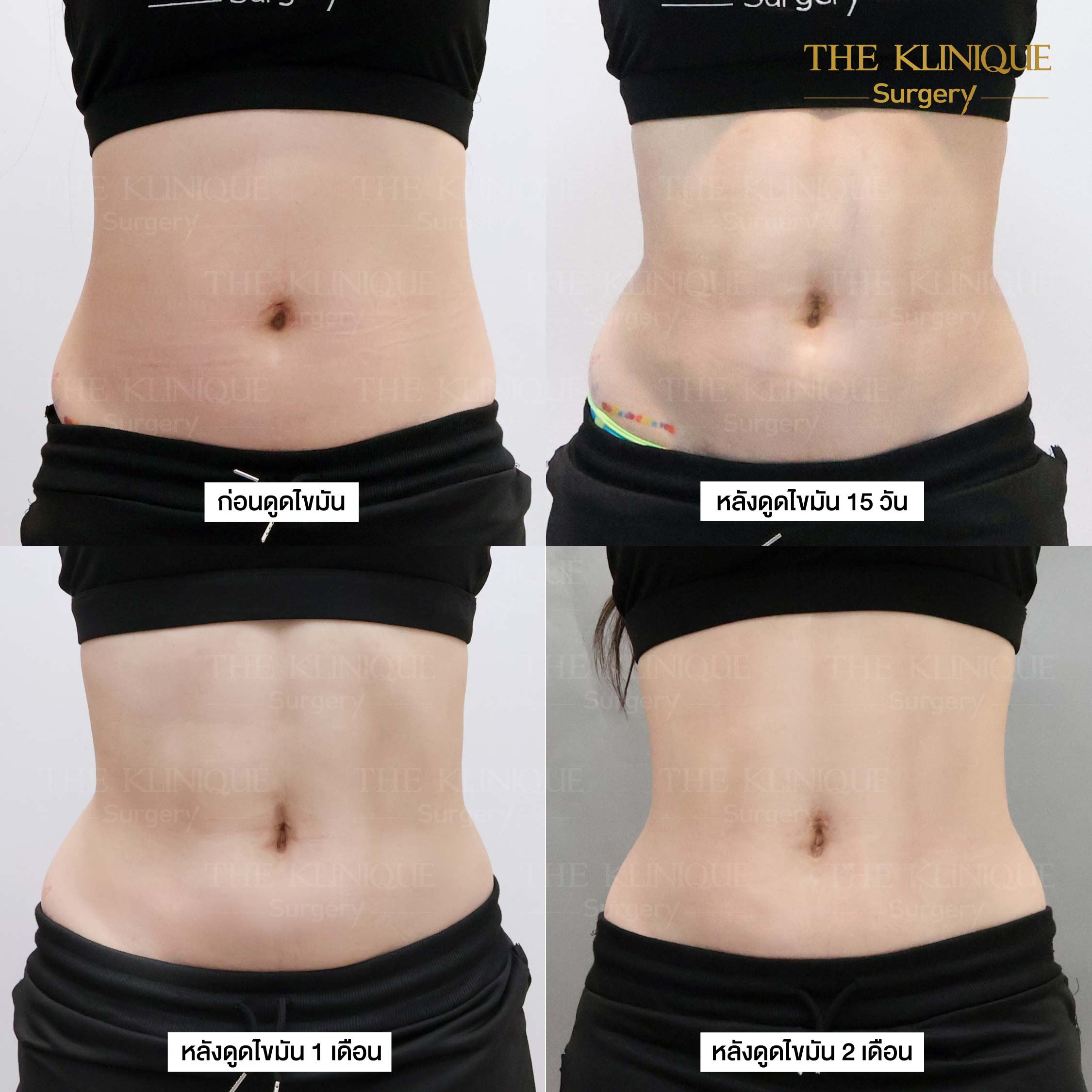 รีวิว ดูดไขมัน (Liposuction) แขน หน้าท้อง