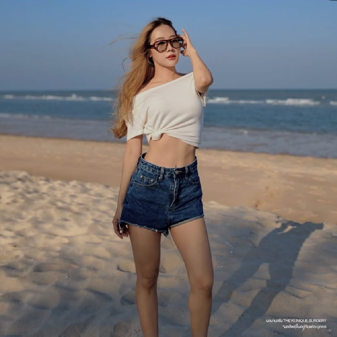 รีวิว ดูดไขมันหน้าท้อง