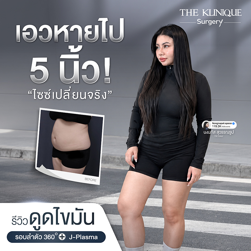 รีวิวดูดไขมันรอบลำตัว