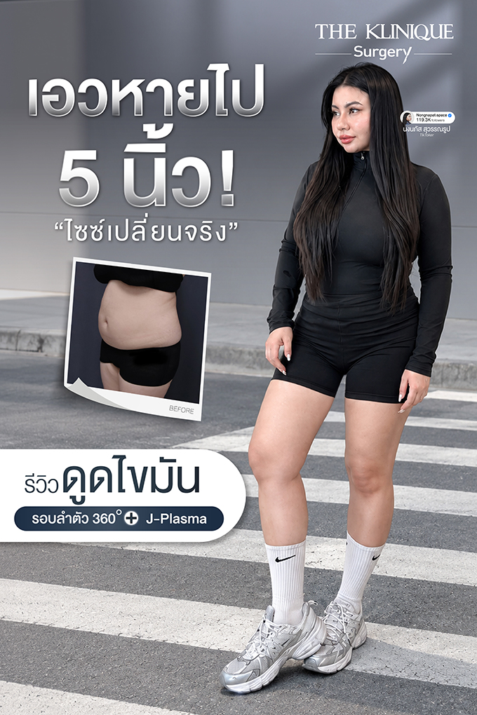 รีวิวดูดไขมันรอบลำตัว 360°