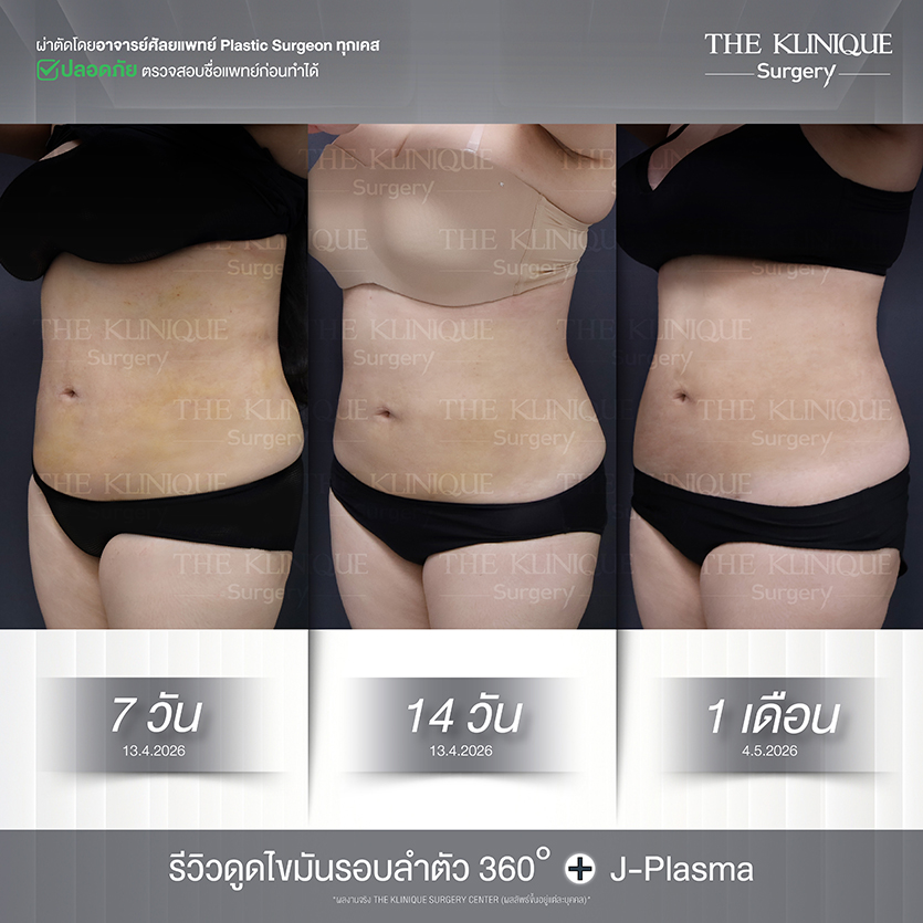 รีวิวดูดไขมัน หมอจอง