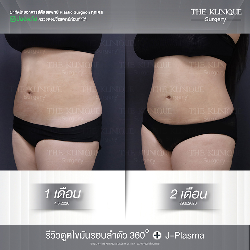 Before After ดูดไขมัน