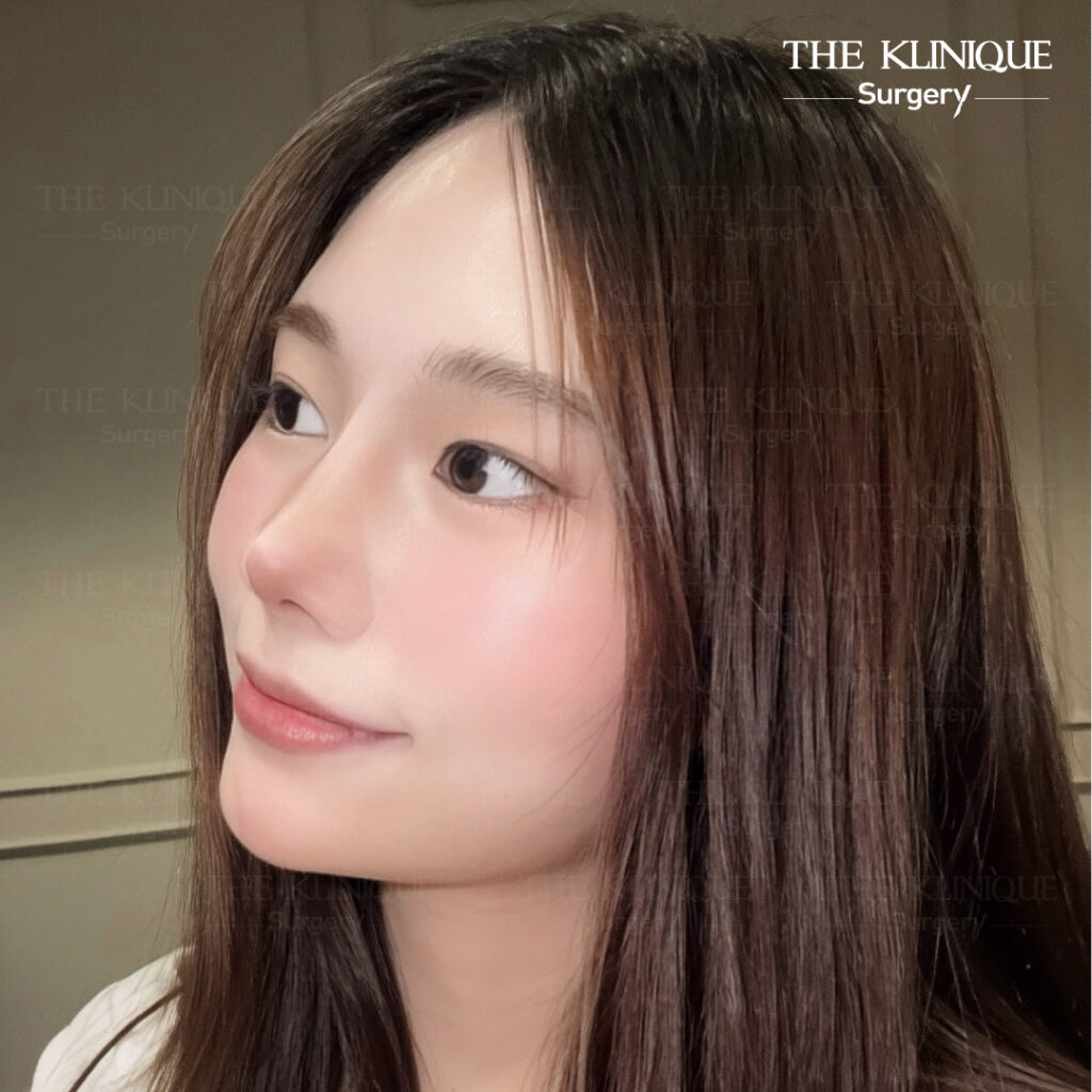 รีวิวเสริมจมูก Semi Open