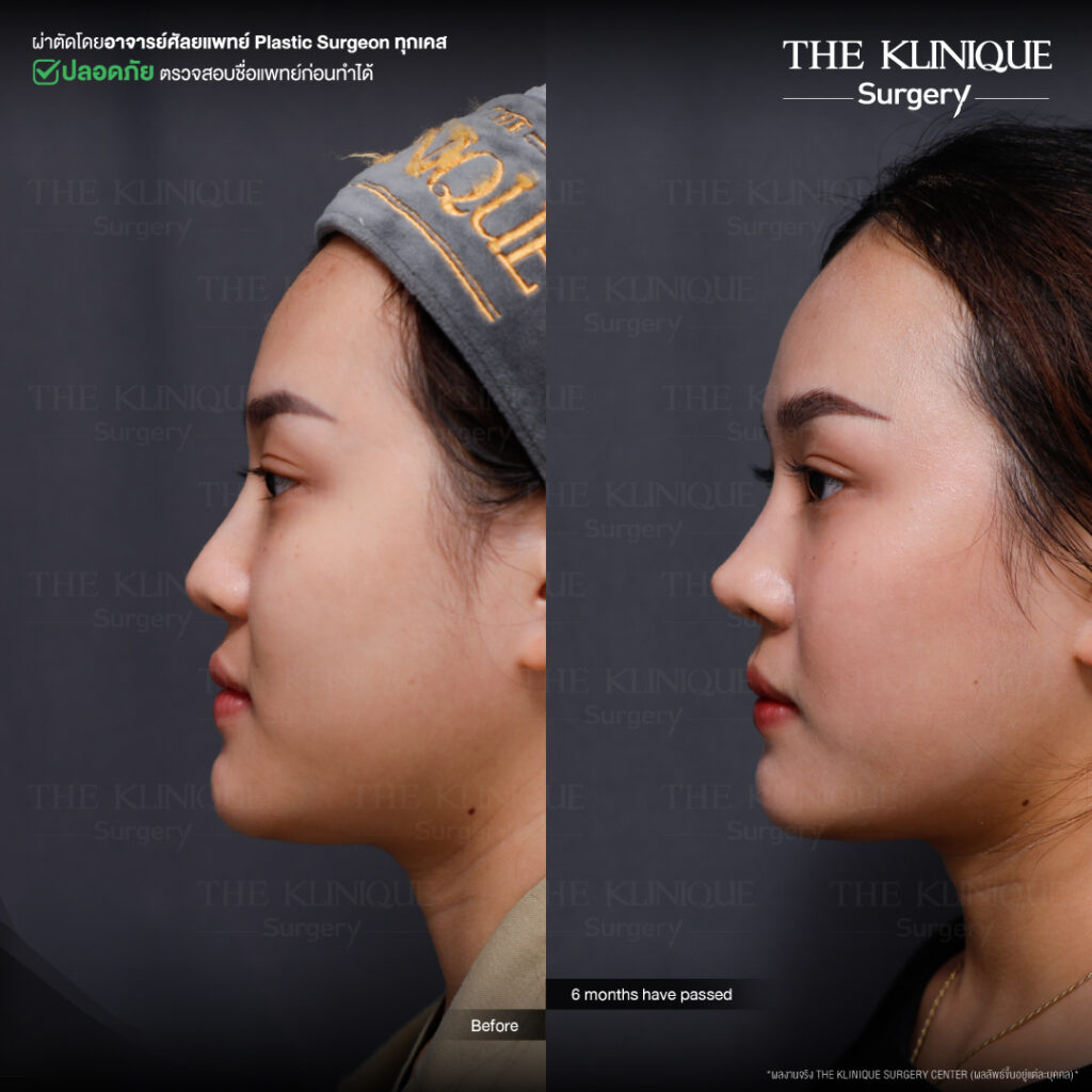 รีวิวเสริมจมูก Semi Open