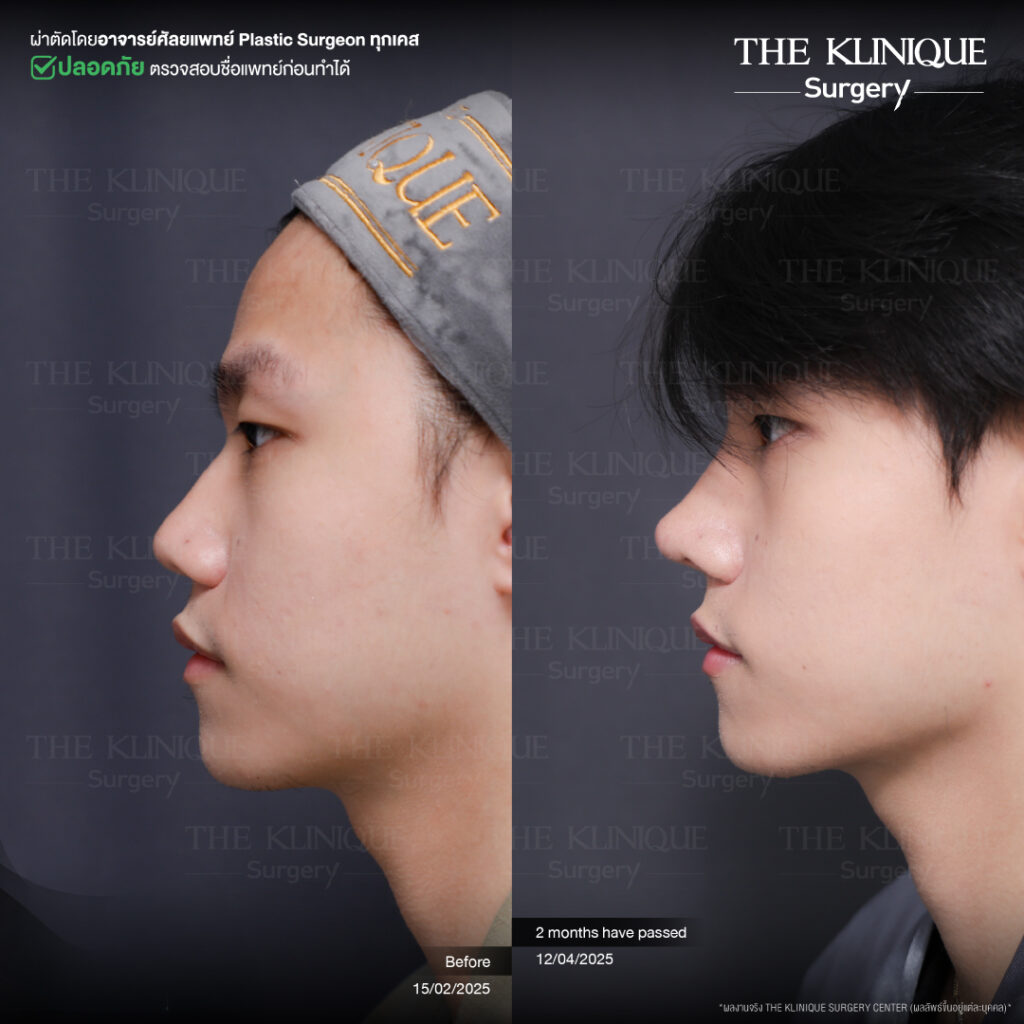 รีวิวเสริมจมูก Semi Open