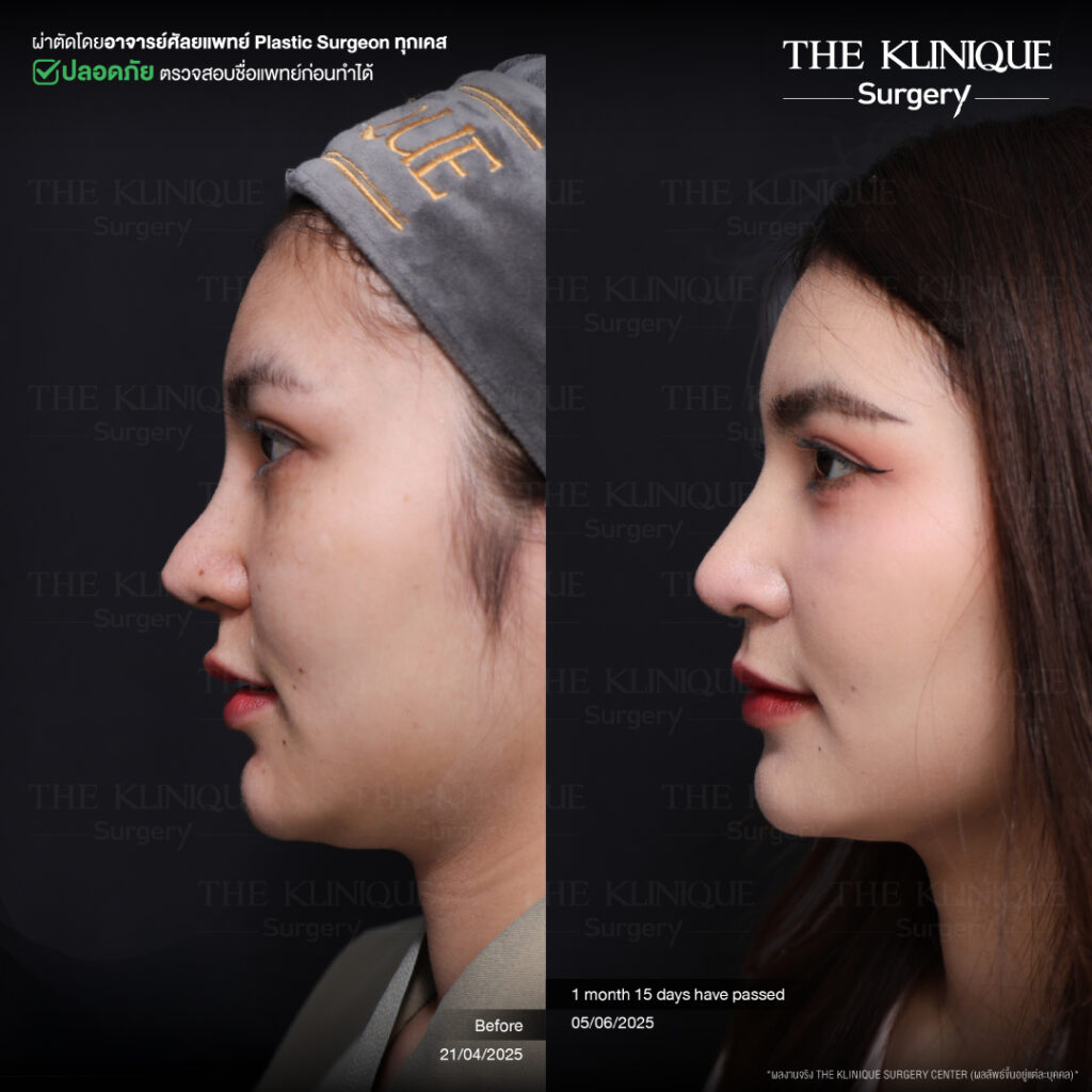รีวิวเสริมจมูก Semi Open