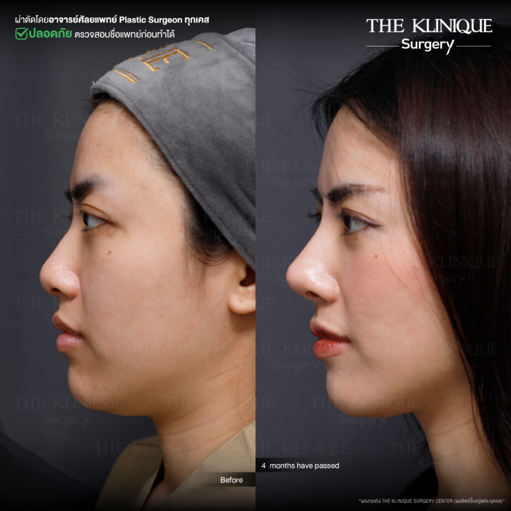 รีวิวเสริมจมูก Semi Open
