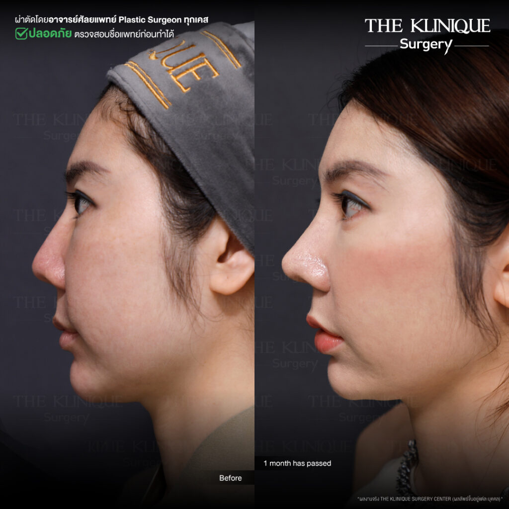 รีวิวเสริมจมูก Semi Open