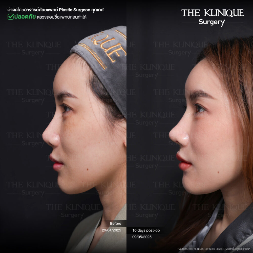 รีวิวเสริมจมูก Semi Open
